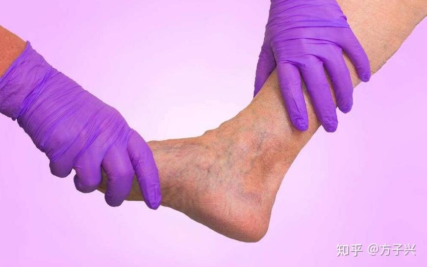 补硒能防治糖尿并发症