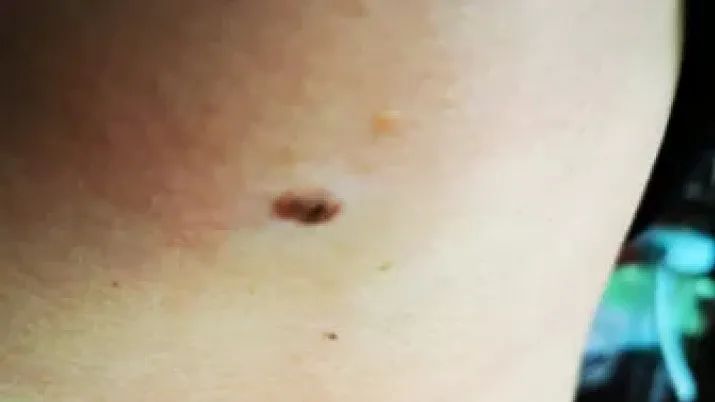 补硒大小便有什么变化