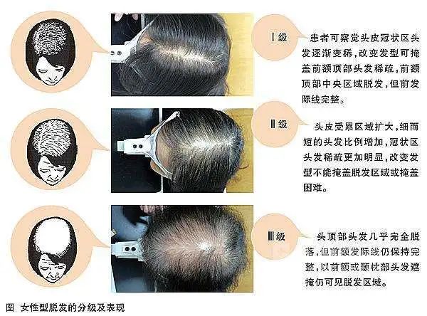 补硒掉头发严重吗女性