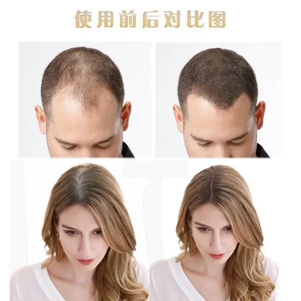 补硒掉头发严重吗女性