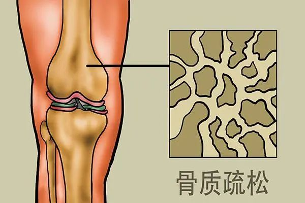骨折补钙吃什么钙片好