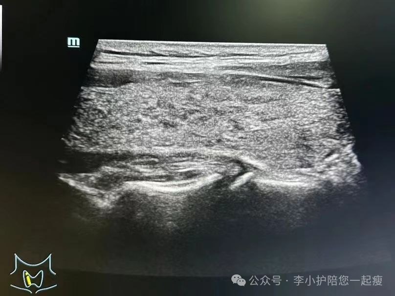 桥本甲减一天补硒多少