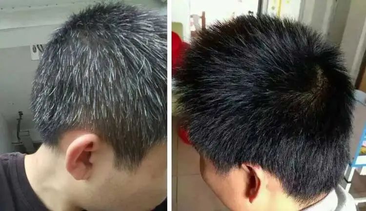 孩子有白头发是缺少什么微量元素