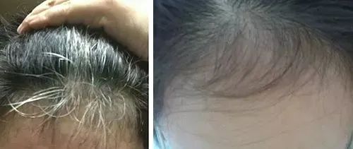孩子有白头发是缺少什么微量元素