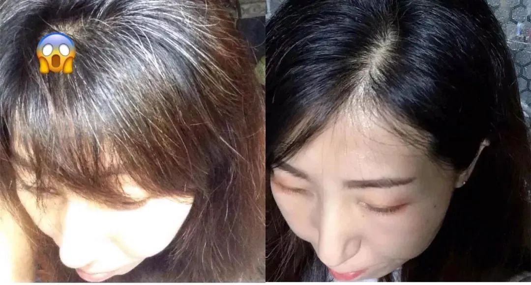 孩子有白头发是缺少什么微量元素