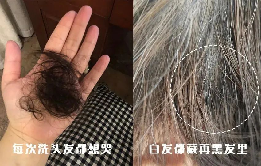 孩子有白头发是缺少什么微量元素