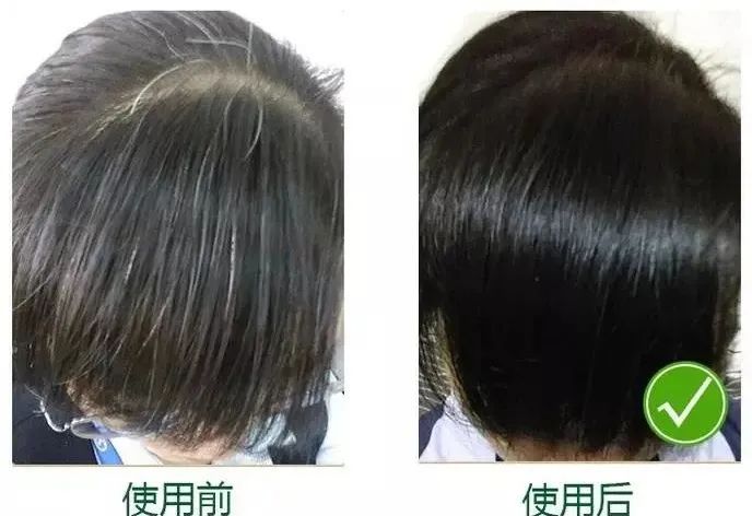孩子有白头发是缺少什么微量元素