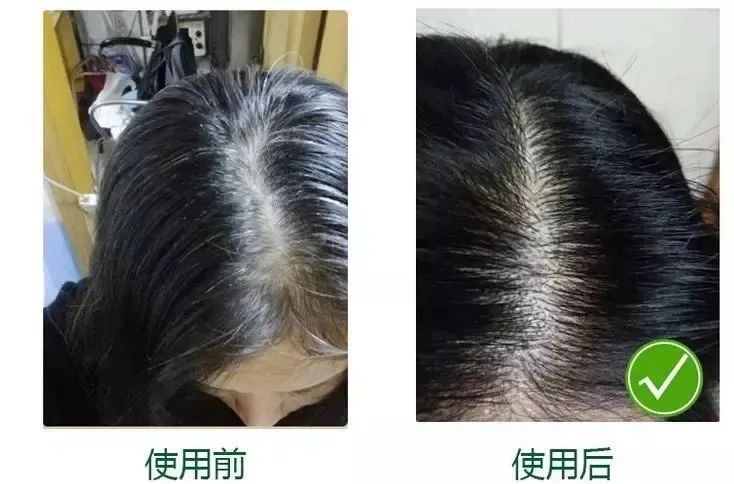孩子有白头发是缺少什么微量元素