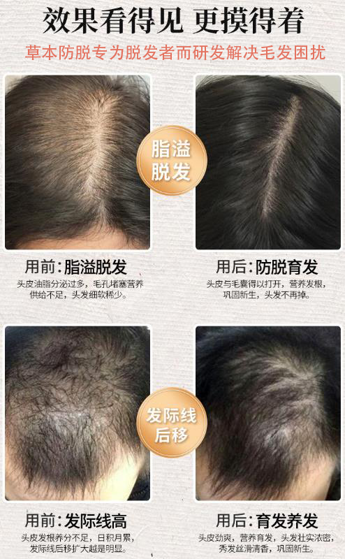 孩子有白头发是缺少什么微量元素