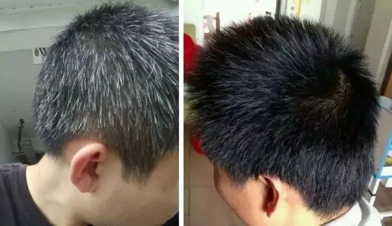 孩子有白头发是缺少什么微量元素