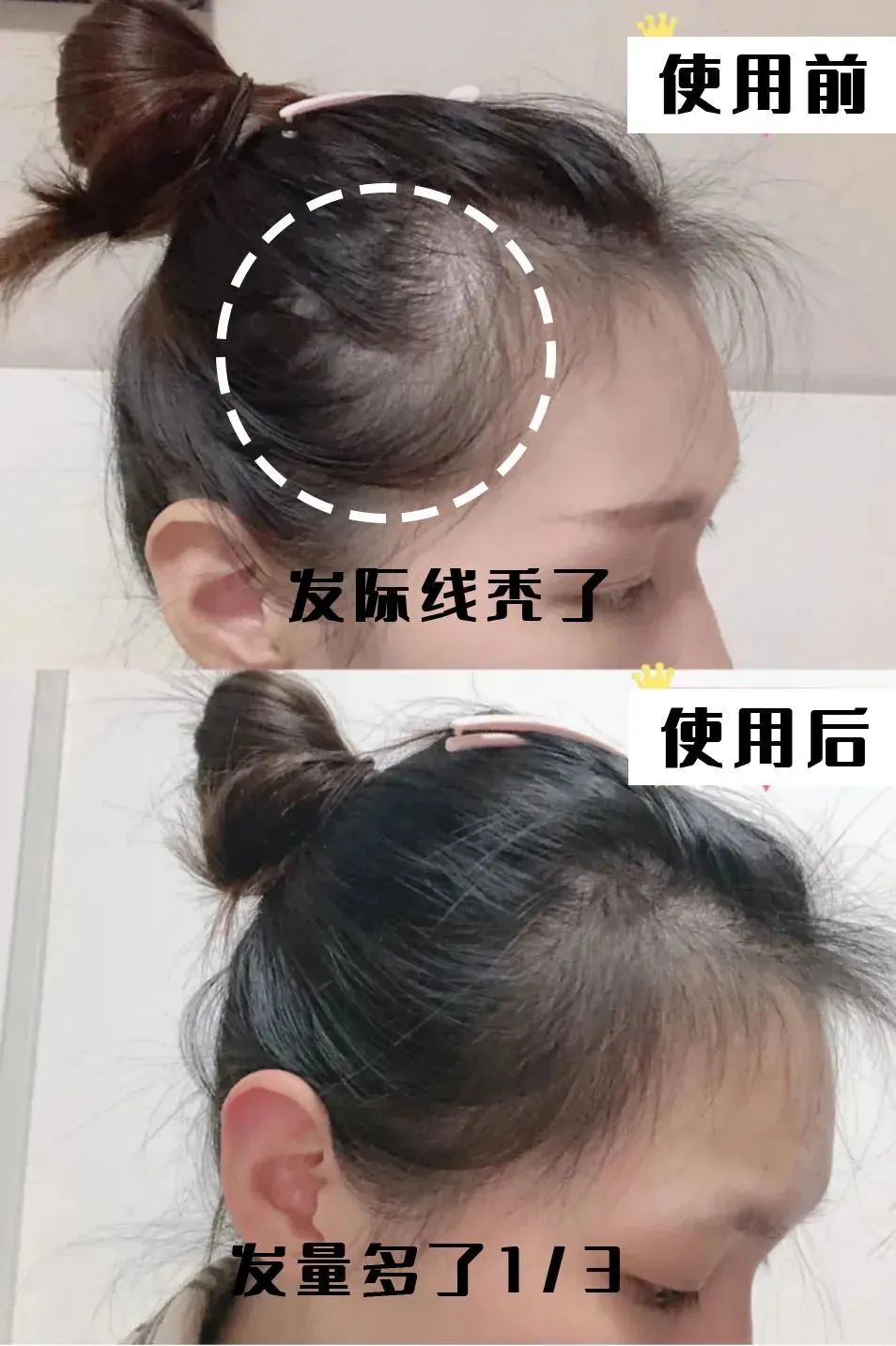孩子有白头发是缺少什么微量元素