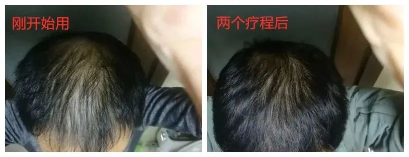 孩子有白头发是缺少什么微量元素