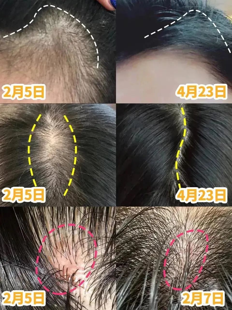 孩子有白头发是缺少什么微量元素