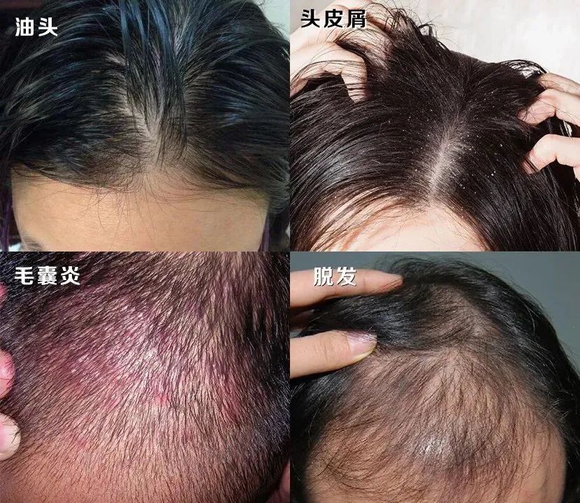 孩子有白头发是缺少什么微量元素