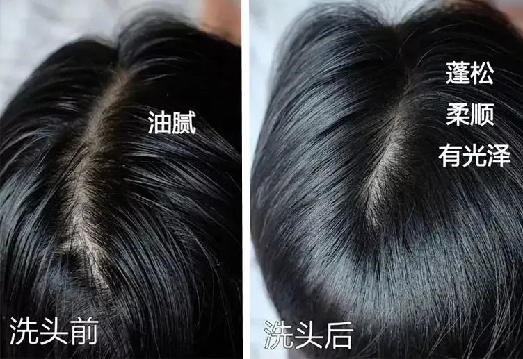 孩子有白头发是缺少什么微量元素