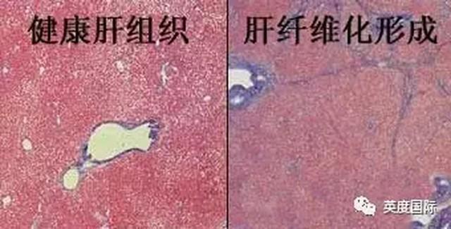 药物性肝损能不能补硒