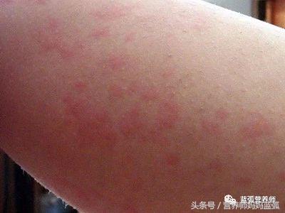 荨麻疹补钙