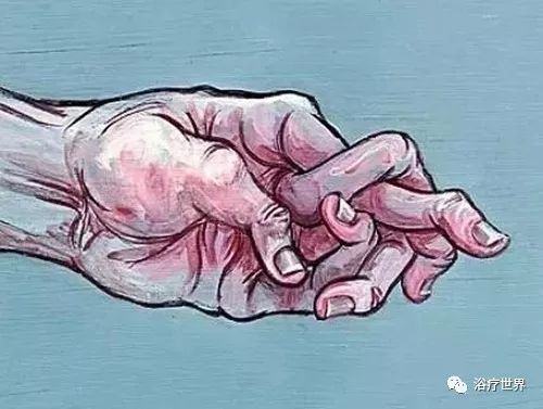 腱鞘炎缺什么微量元素