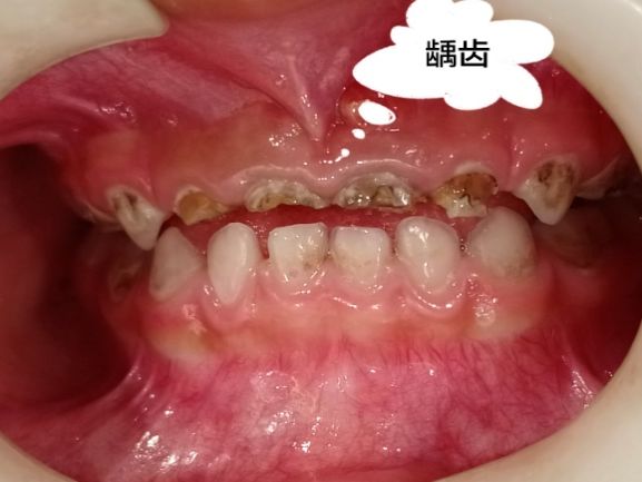 补铁牙齿变黑了怎么办