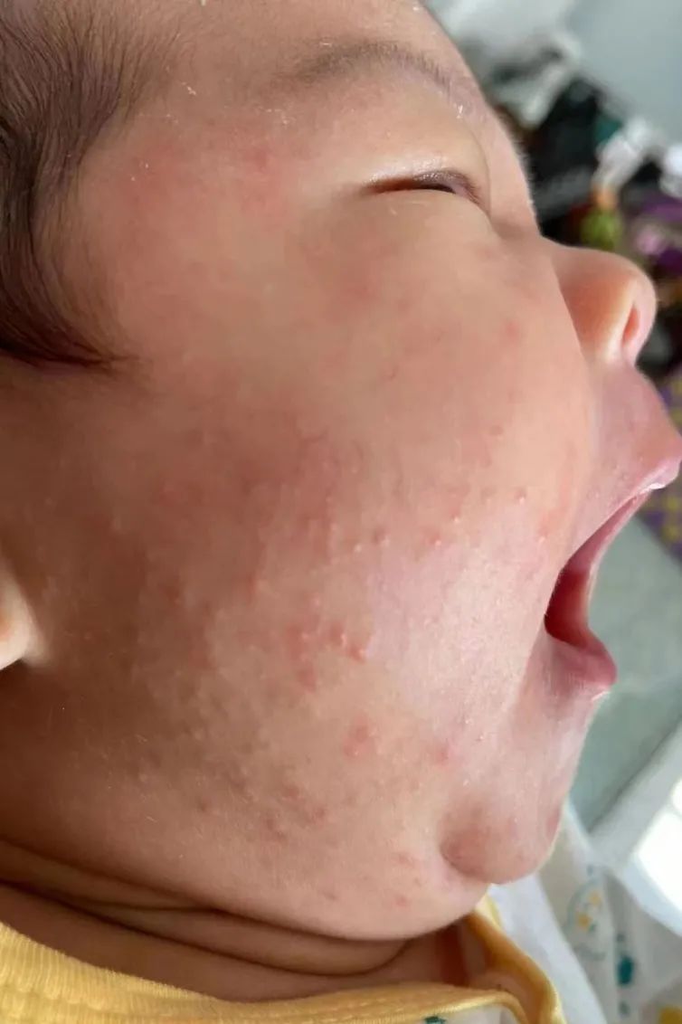 荨麻疹能吃锌硒宝片吗