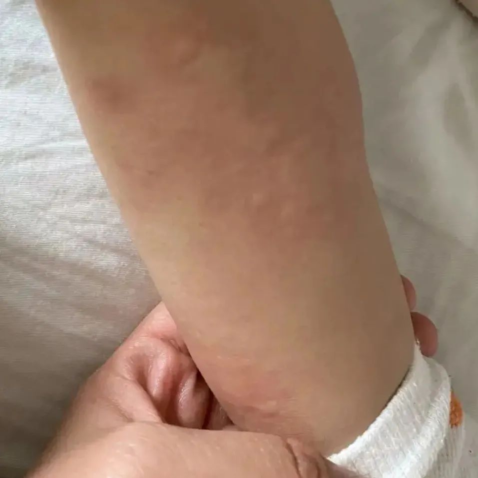 荨麻疹能吃锌硒宝片吗