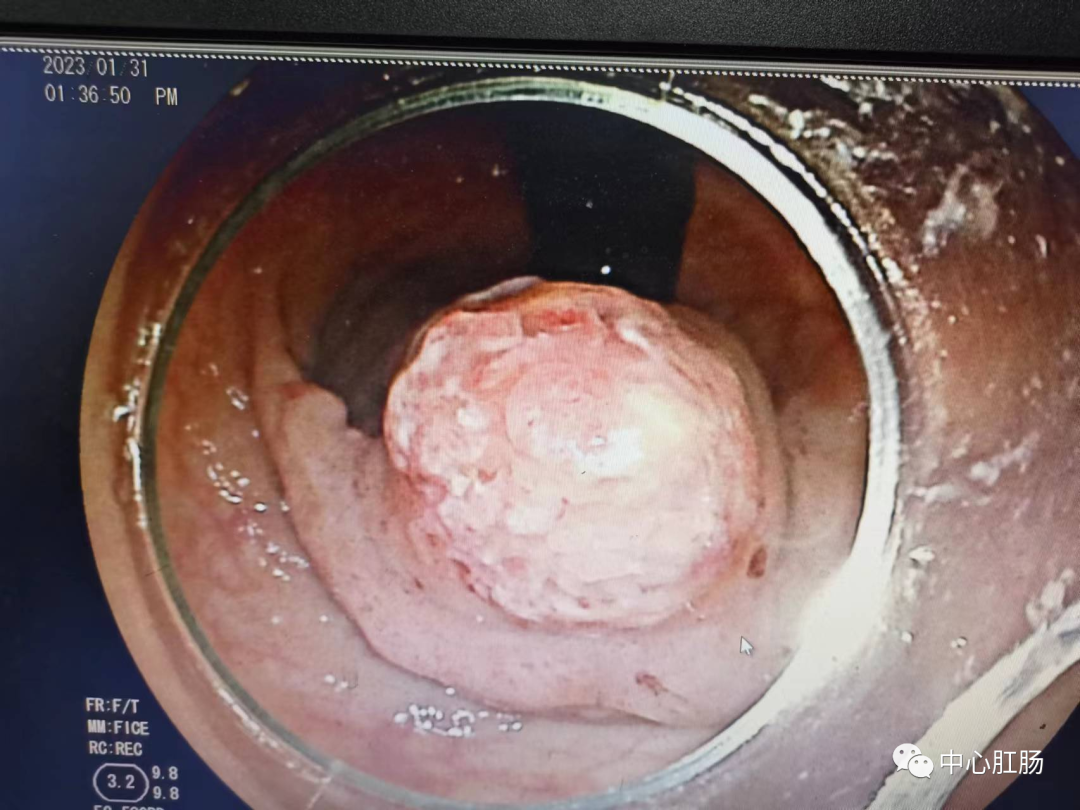 管状腺瘤切除可以补硒吗