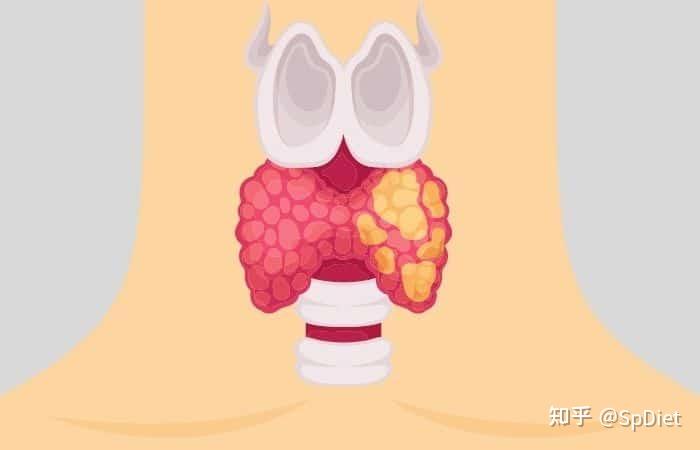 桥本甲状腺炎是不是补硒