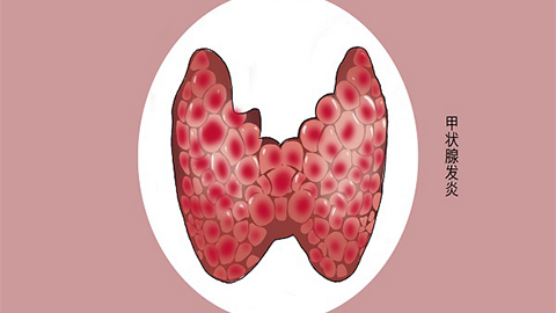 桥本甲状腺炎是不是补硒