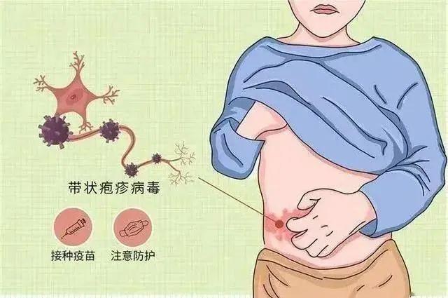 得过带状疱疹需要补硒吗