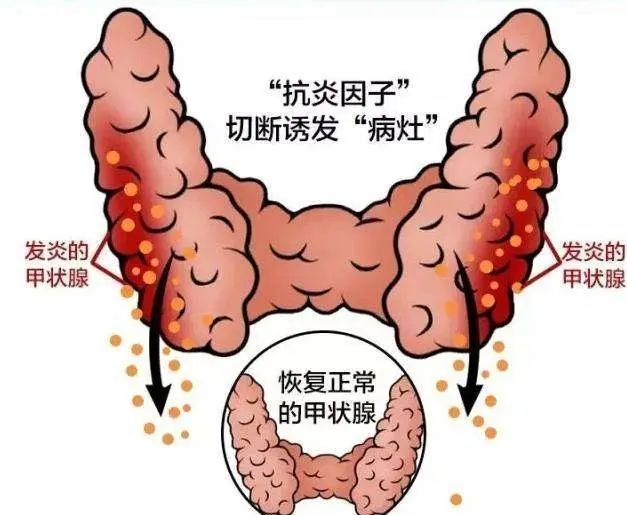补硒可以调节甲状腺炎吗