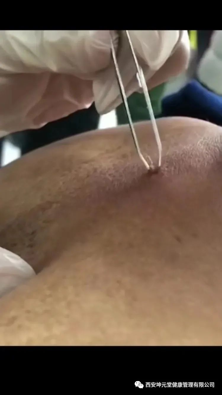 羊毛疔是不是缺硒怎样补