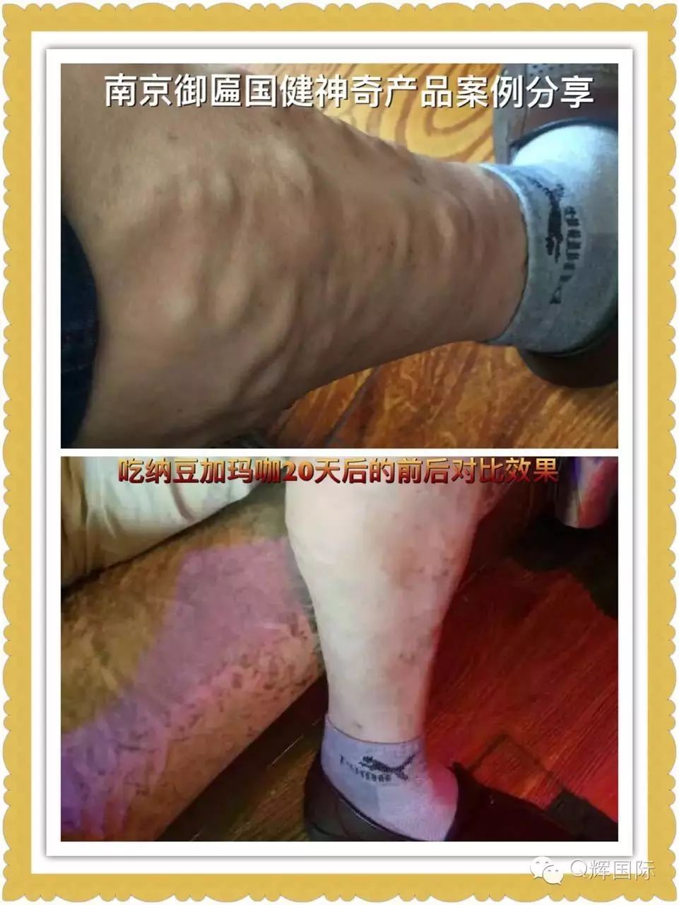 长期吃降压药缺硒怎么补