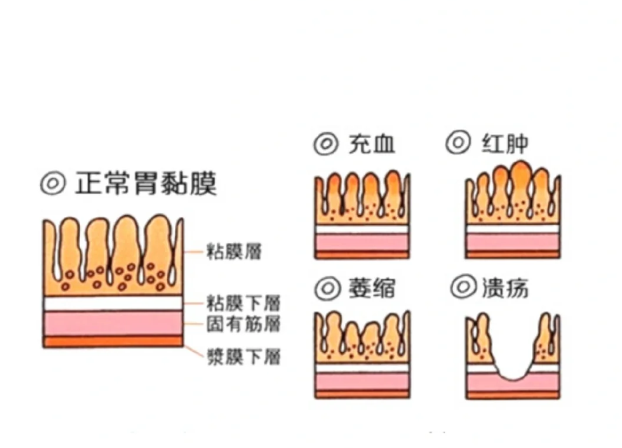 萎缩性胃炎怎样补硒的呢