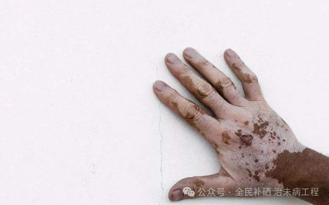 甲亢用不用补硒的维生素