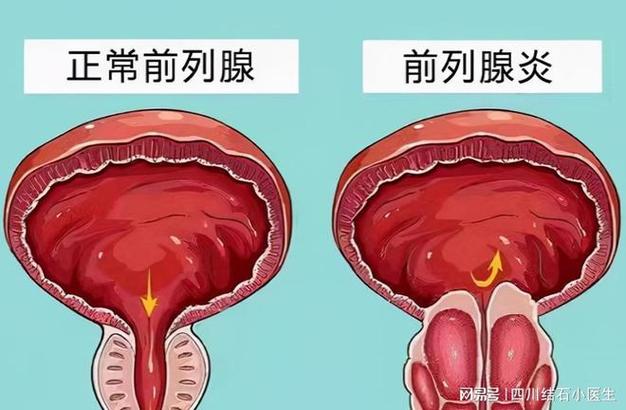 锌硒宝对前列腺炎有用吗