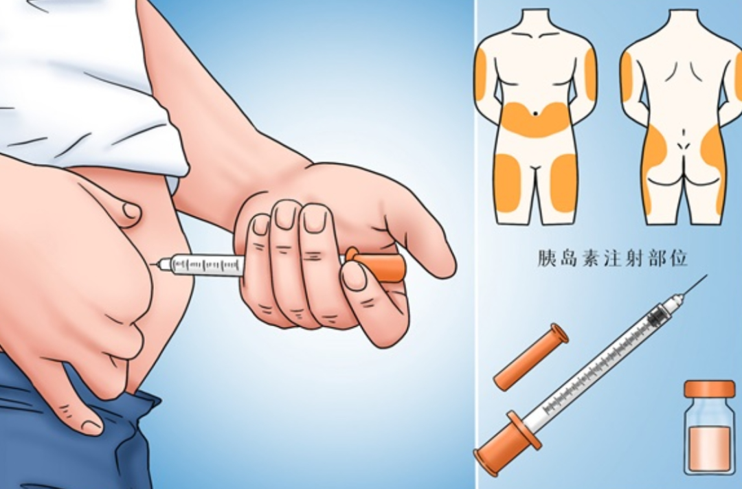 用司美格鲁肽减肥有后遗症吗