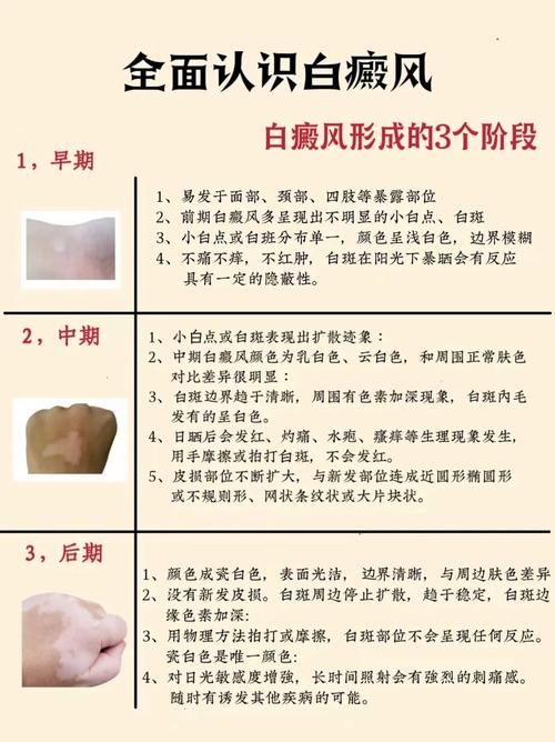 白癜风补硒吗