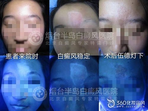 白癜风补硒吗