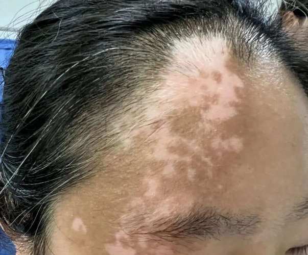 白癜风补硒吗
