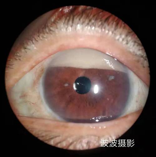 眼球突出补硒