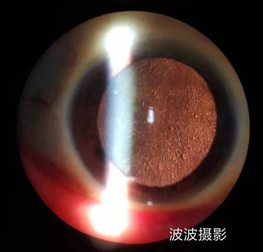 眼球突出补硒