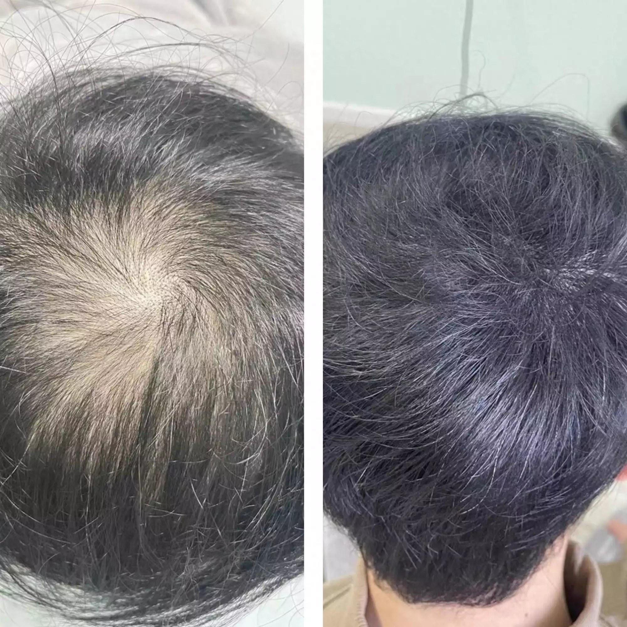 脱发补硒元素