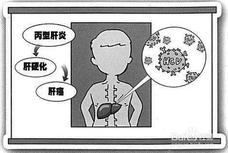 肝炎的早期症状有哪些？
