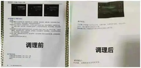 桥本结节补硒