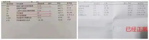 桥本结节补硒