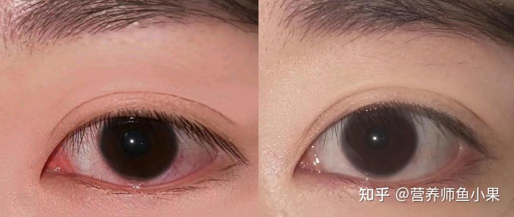 眼睛补硒价格