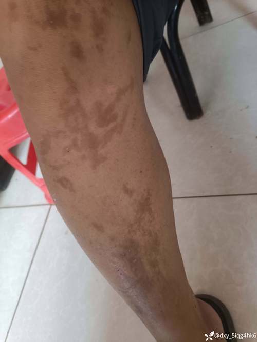补硒导致长斑
