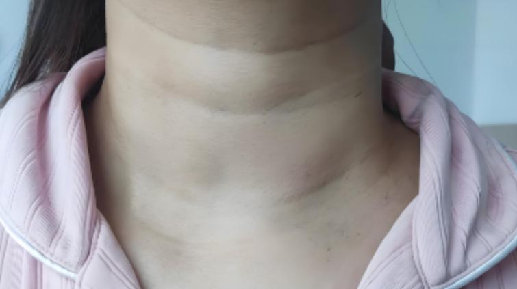 玉米能补硒吗(紫甘蓝甲状腺)-硒宝网