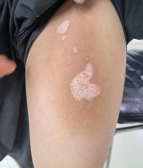 补硒 皮肤病(硒与白癜风)-硒宝网