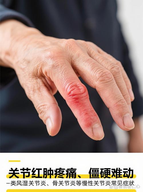 补硒对类风湿(手指类风湿性关节炎吃什么药好)-硒宝网